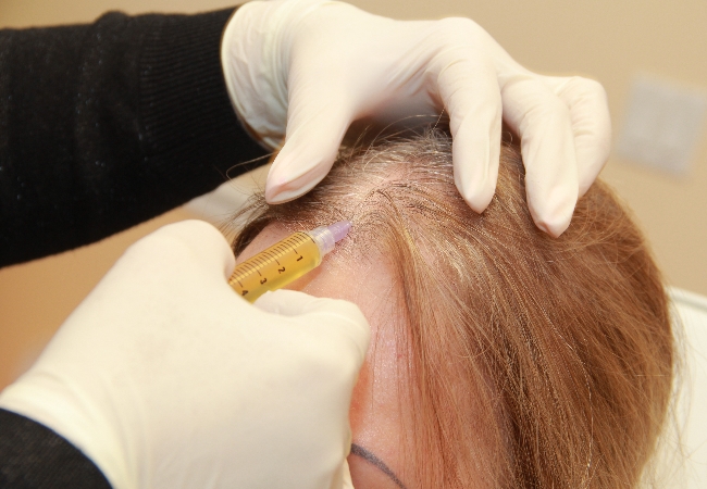 Tratamiento de plasma rico en plaquetas para la alopecia
